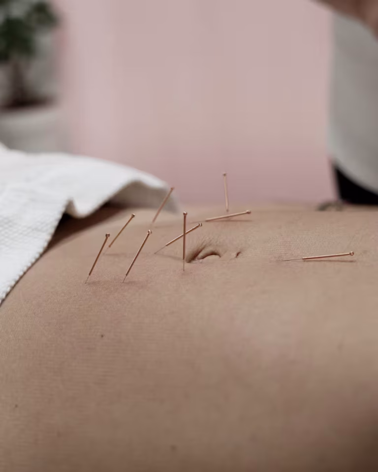 Acupuntura